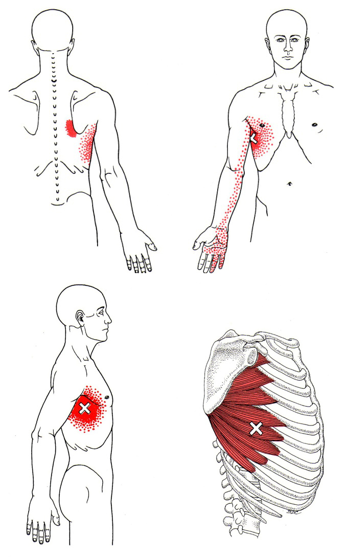 Muskel Der Seitlichen Thoraxwand The Trigger Point And Referred Pain Guide